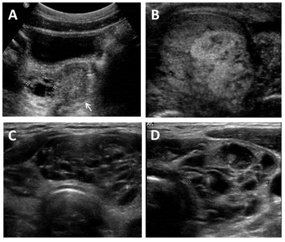 Imágenes ecográficas en el Síndrome de McCune-Albright